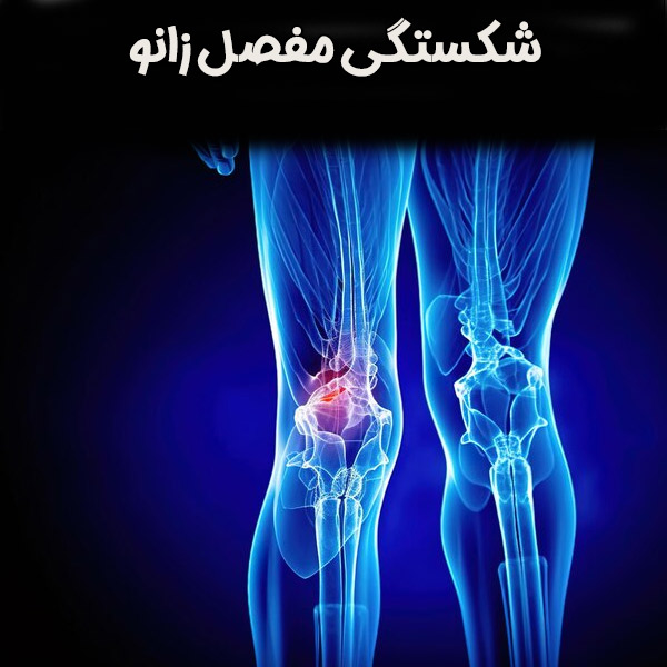 شکستگی مفصل زانو - دکتر عسکری