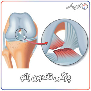پارگی تاندون زانو و درمان آن در تهران - دکتر علیرضا عسکری