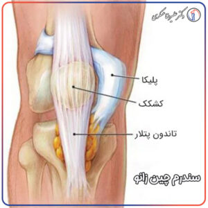سندرم چین زانو و راه های درمان آن در تهران - دکتر عسکری