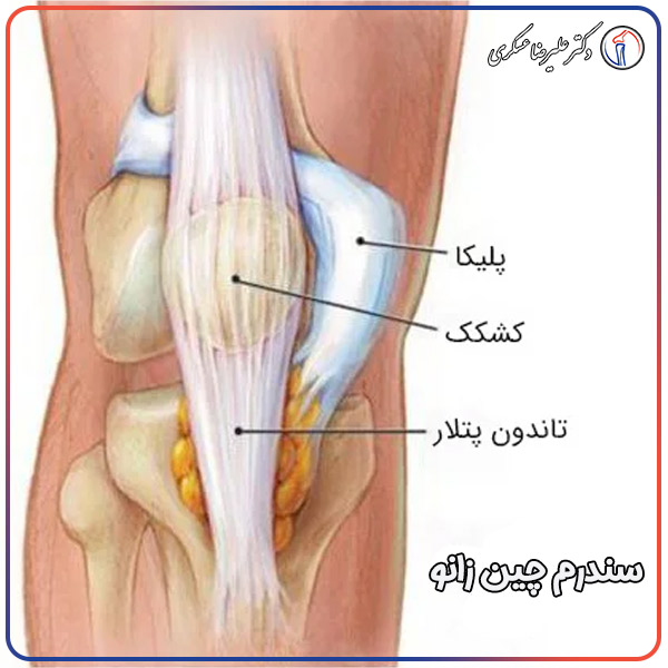 سندرم چین زانو و راه های درمان آن - دکتر عسکری