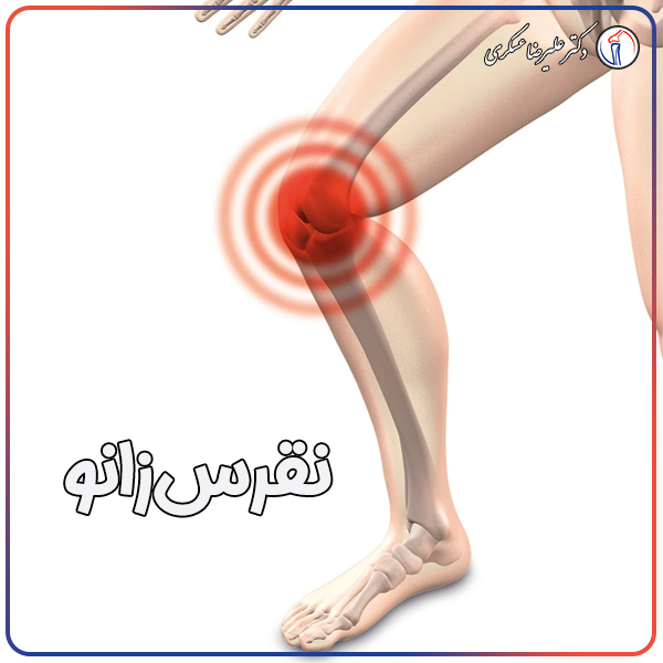 نقرس زانو و راه های درمان آن در تهران - دکتر علیرضا عسکری
