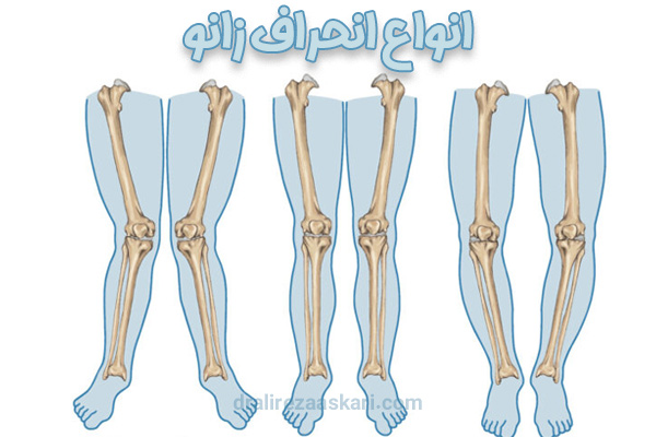انواع انحراف زانو - دکتر علیرضا عسکری