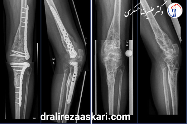 عکس شکستگی مفصل زانو - ئکتر علیرضا عسکری