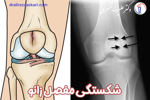شکستگی مفصل زانو - دکتر عسکری
