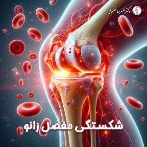 شکستگی مفصل زانو - دکتر علیرضا عسکری