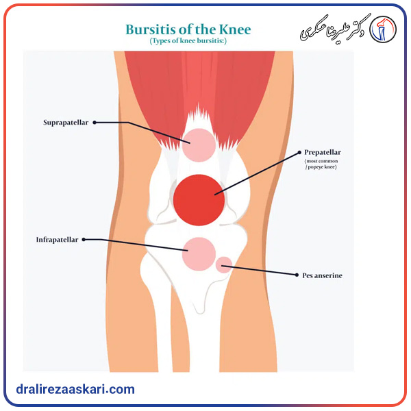 انواع بورسیت زانو - دکتر علیرضا عسکری