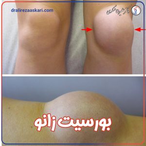 بورسیت زانو - دکتر علیرضا عسکری