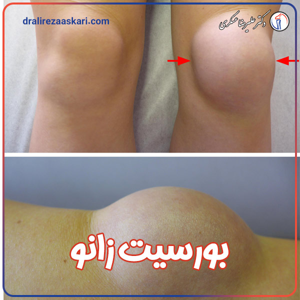 بورسیت زانو - دکتر علیرضا عسکری