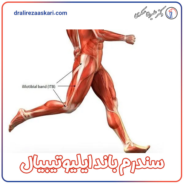 سندرم باند ایلیوتیبیال - دکتر عسکری