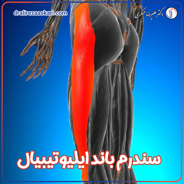 سندرم باند ایلیوتیبیال - دکتر عسکری