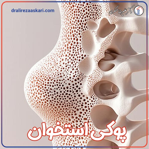 پوکی استخوان - دکتر عسکری