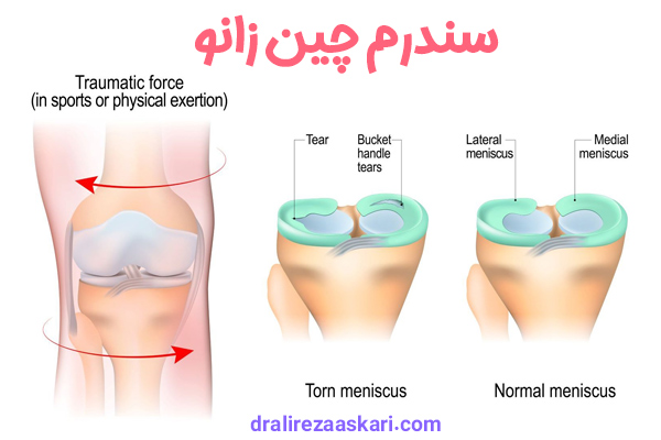 سندرم چین زانو - دکتر عسکری