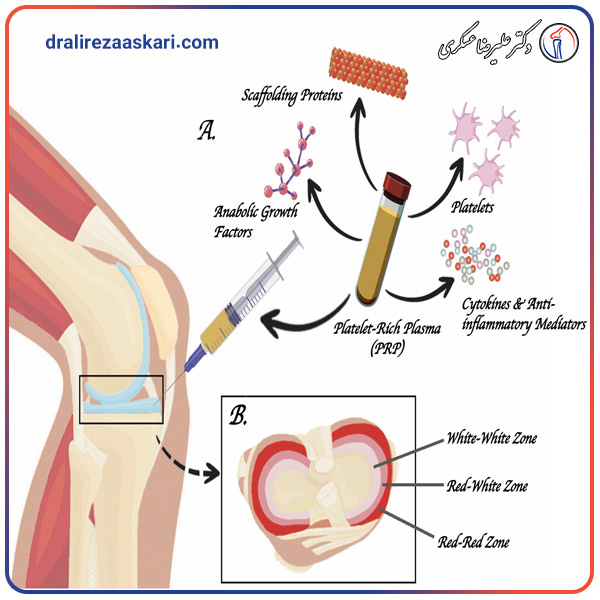 پی ار پی زانو - دکتر عسکری
