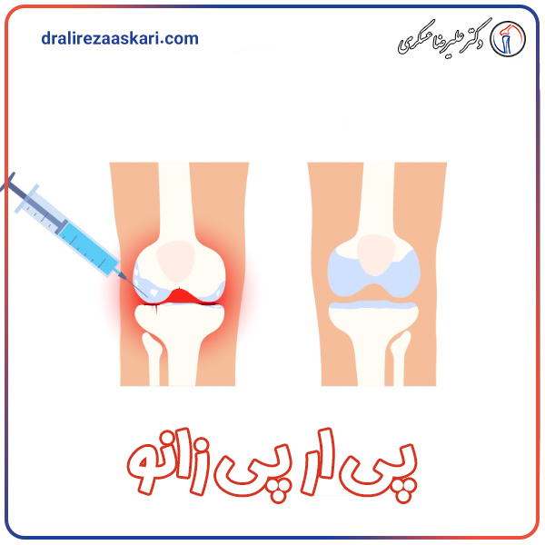 پی ار پی زانو - دکتر علیرضا عسکری