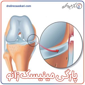 پارگی مینیسک زانو - دکتر عسکری