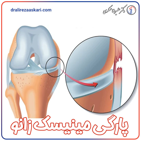 پارگی مینیسک زانو - دکتر عسکری