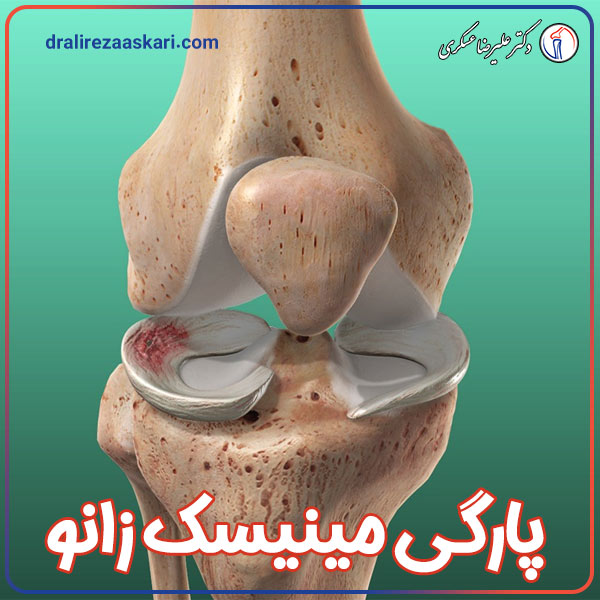 پارگی مینیسک زانو - دکتر عسکری