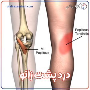 درد پشت زانو - دکتر علیرضا عسکری