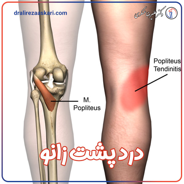درد پشت زانو - دکتر علیرضا عسکری