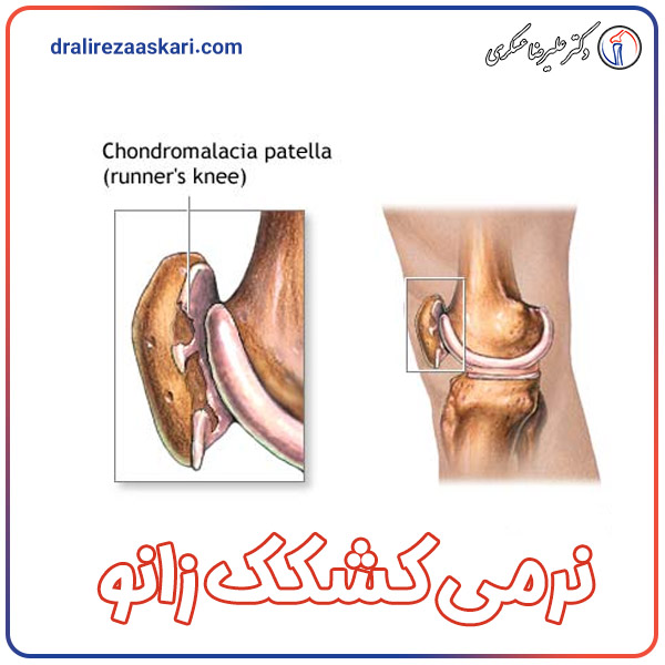 نرمی کشکک زانو - دکتر علیرضا عسکری