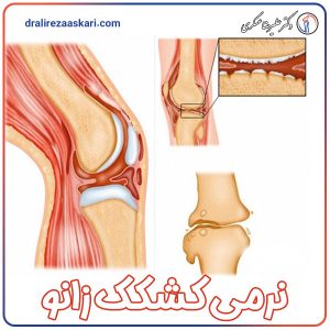 نرمی کشکک زانو - دکتر علیرضا عسکری