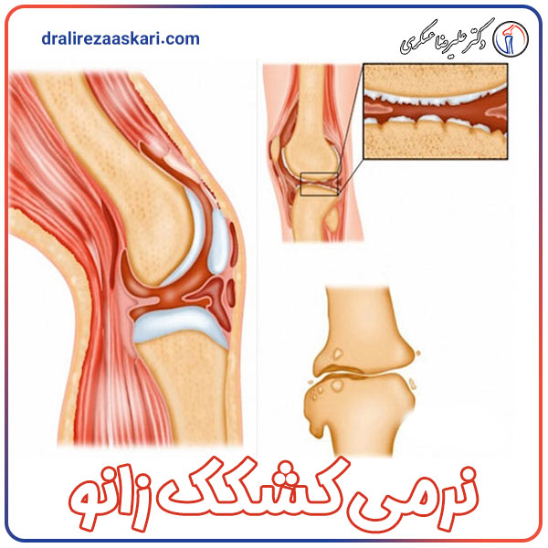 نرمی کشکک زانو - دکتر علیرضا عسکری