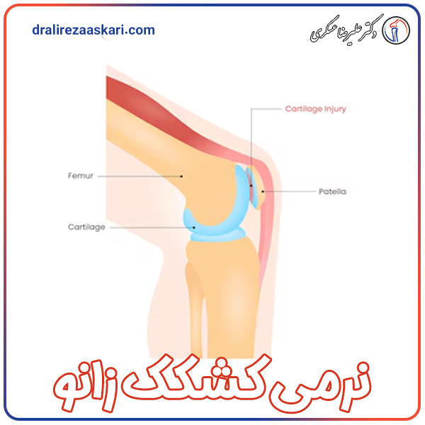 نرمی کشکک زانو - دکتر علیرضا عسکری