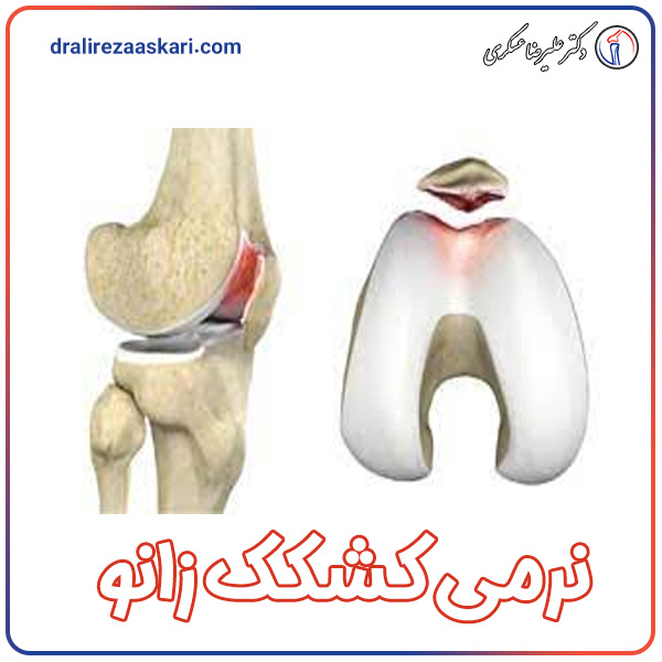 نرمی کشکک زانو - دکتر علیرضا عسکری