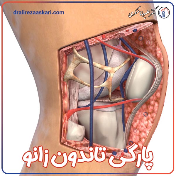پارگی تاندون زانو | دکتر علیرضا عسکری