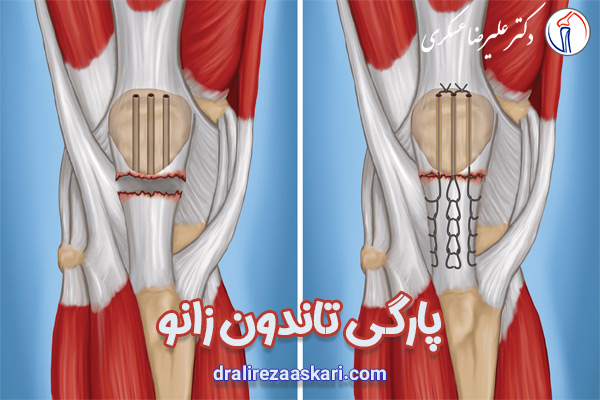 پارگی تاندون زانو | دکتر علیرضا عسکری