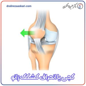 انحراف یا کجی کشکک زانو - دکتر علیرضا عسکری