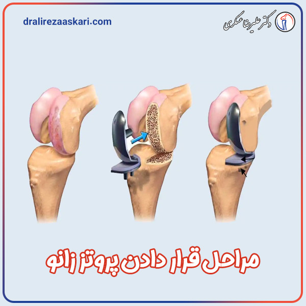 پروتز زانو - دکتر علیرضا عسکری