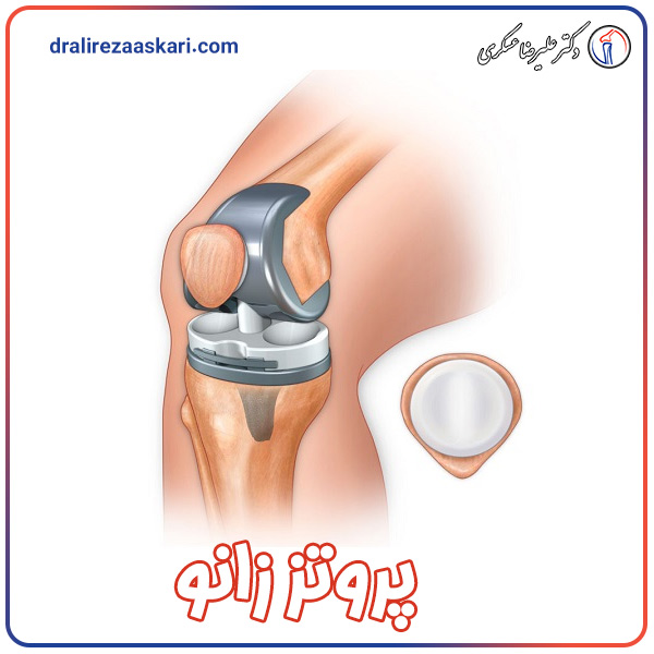 پروتز زانو - دکتر علیرضا عسکری