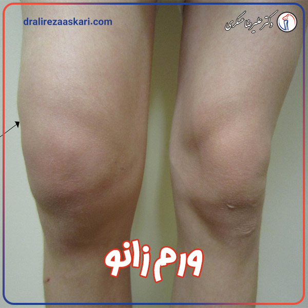 ورم زانو - دکتر علیرضا عسکری