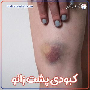 کبودی پشت زانو - دکت علیرضا عسکری
