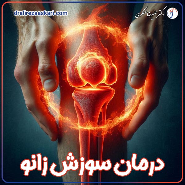 درمان سوزش زانو - دکتر علیرضا عسکری