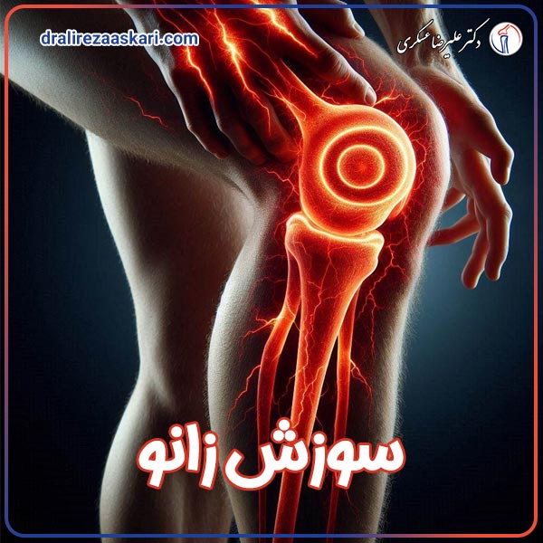 سوزش زانو - دکتر علیرضا عسکری