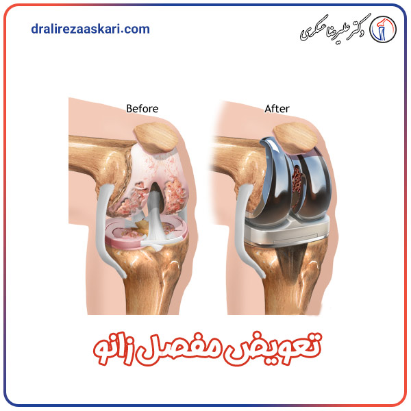 جراحی تعویض مفصل زانو - دکتر علیرضا عسکری