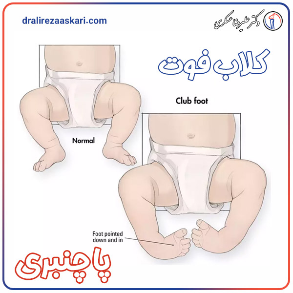 پا چنبری یا کلاب فوت - دکتر علیرضا عسکری