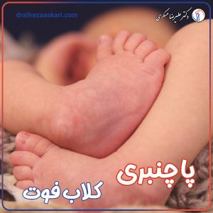 پا چنبری یا کلاب فوت - دکتر علیرضا عسکری