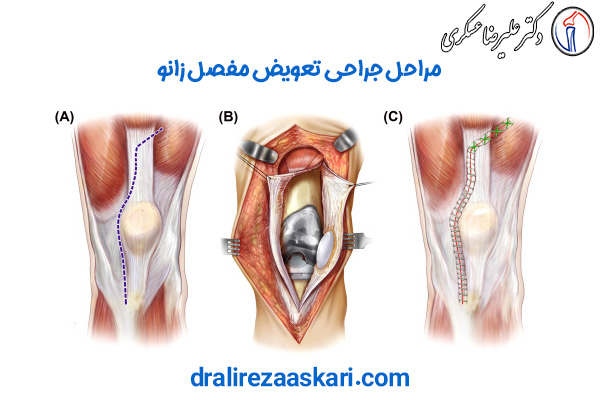 جراحی تعویض مفصل زانو - دکتر علیرضا عسکری