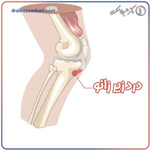 درد زیر زانو - دکتر عسکری