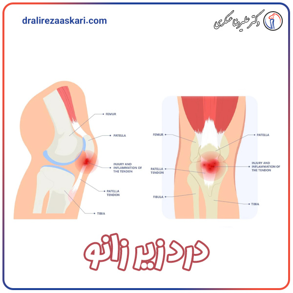 درد زیر زانو - دکتر عسکری
