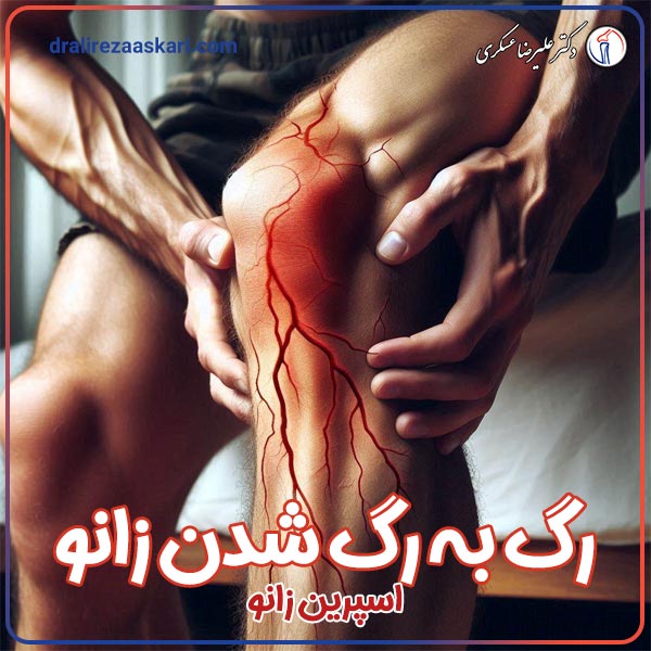 رگ به رگ شدن زانو - دکتر علیرضا عسکری