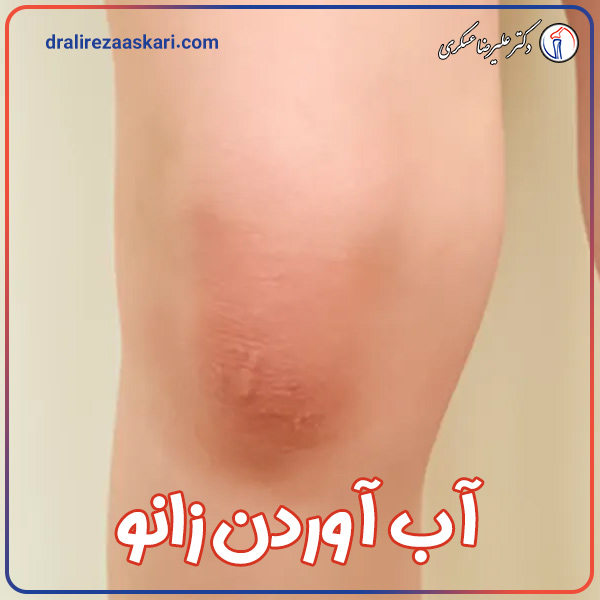 آب آوردن زانو | دکتر عسکری