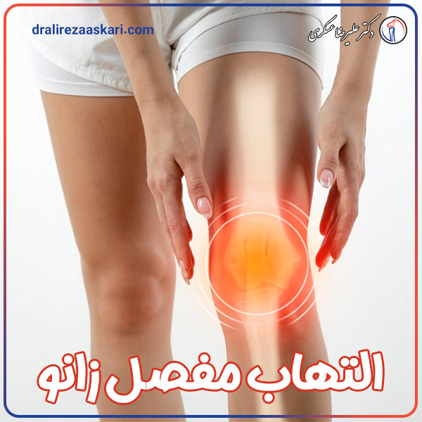 &nbsp;التهاب مفصل زانو - دکتر علیرضا عسکری