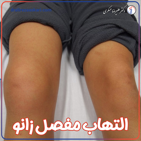 &nbsp;التهاب مفصل زانو - دکتر علیرضا عسکری