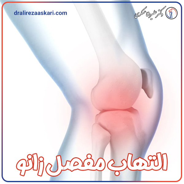 &nbsp;التهاب مفصل زانو - دکتر علیرضا عسکری