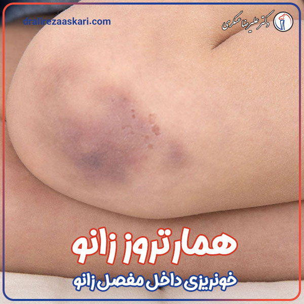 همارتروز زانو  - دکتر علیرضا عسکری 