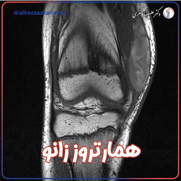 همارتروز زانو  - دکتر علیرضا عسکری 